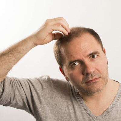 Top Home Remedies for Male Pattern Baldness
