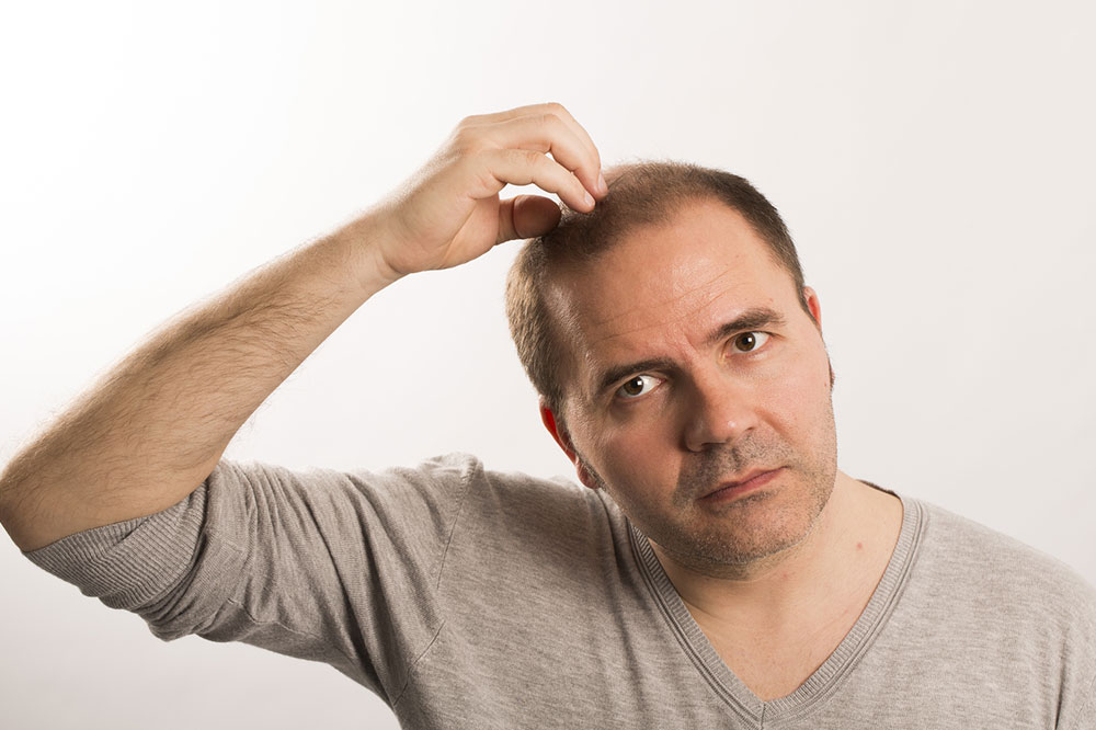 Top Home Remedies for Male Pattern Baldness